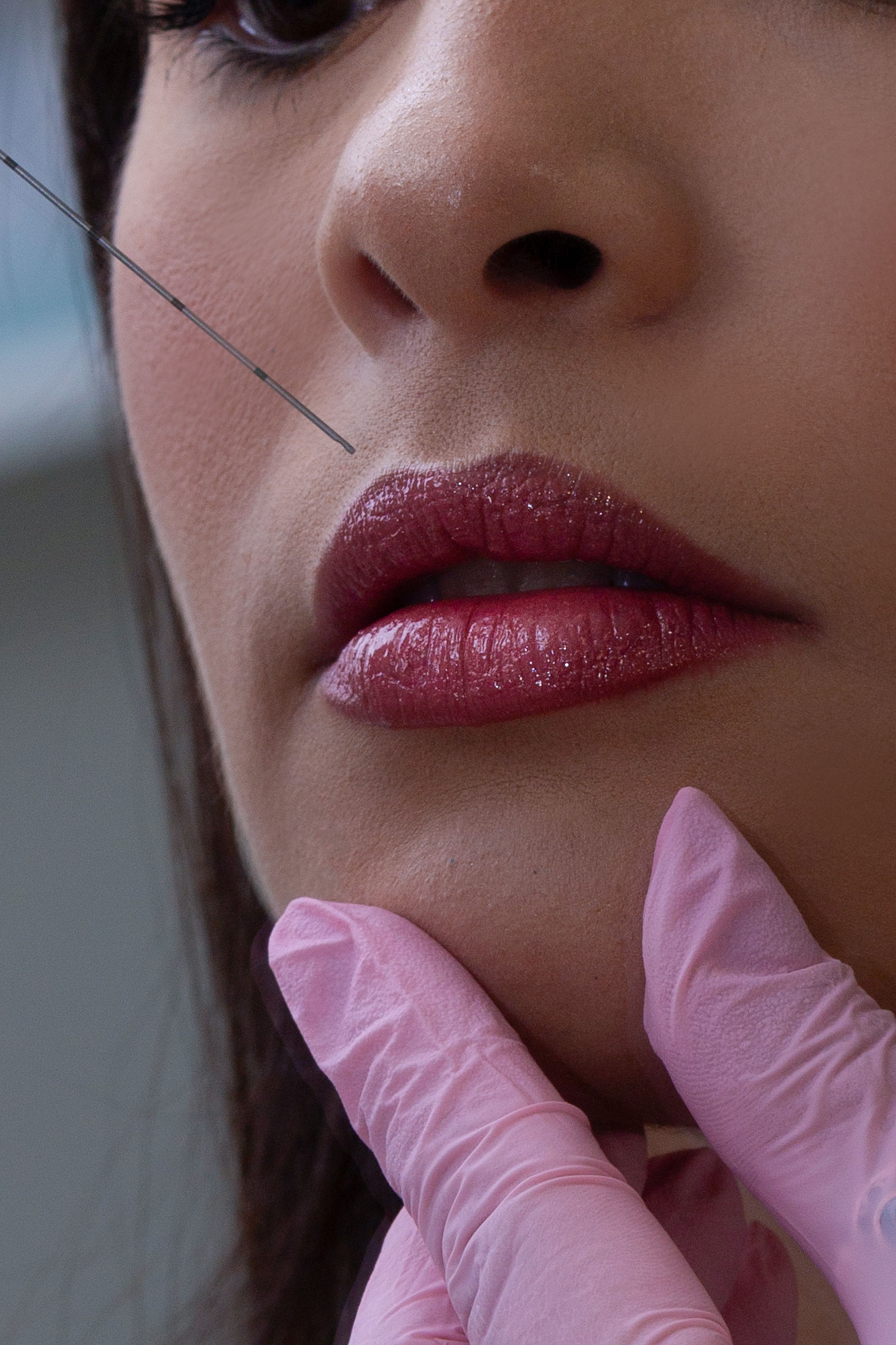 Lips treatment case 3